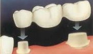Cabinet stomatologic Dr. Tudor Balc - Protetica dentara