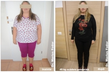 Micșorare stomac slăbire 45 kg