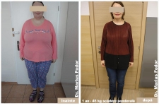 Micșorare stomac slăbire 45 kg