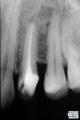 Aspect radiografic imediat dupa terminarea tratamentului endodontic