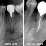 Tratament endodontic