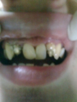 Reconstrucție dentară LORIMED înainte