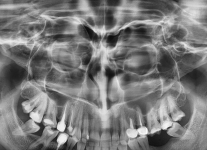 Radiografie digitală panoramică sinusuri